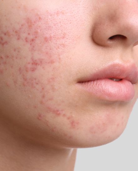 acne tratamiento estetico
