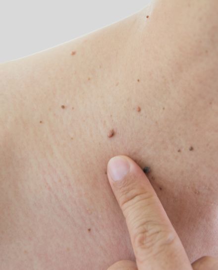 verrugas
